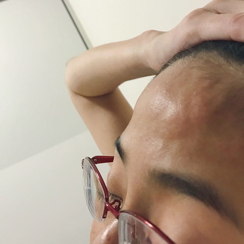 Inflamed blood vessels popping out on my forehead.